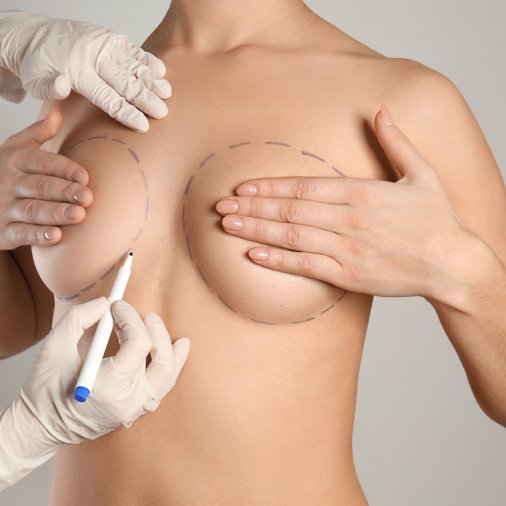 Doctor,Drawing,Marks,On,Female,Breast,Before,Cosmetic,Surgery,Operation